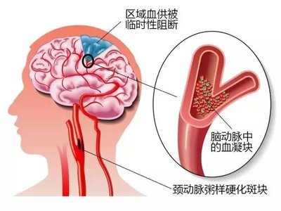 刘振大夫：戒备！脑梗多收，那五个前兆切莫忽视-1.jpg